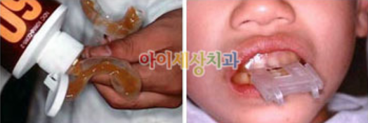 불소도포